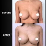 Before and after breast augmentation with fat transfer results at ID Clinic Bangkok