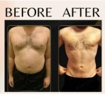 Before and after tummy tuck and liposuction results at ID Clinic Bangkok, improved body contour