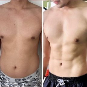 Before and after tummy tuck and liposuction results at ID Clinic Bangkok, defined abs visible