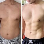 Before and after tummy tuck and liposuction results at ID Clinic Bangkok, defined abs visible