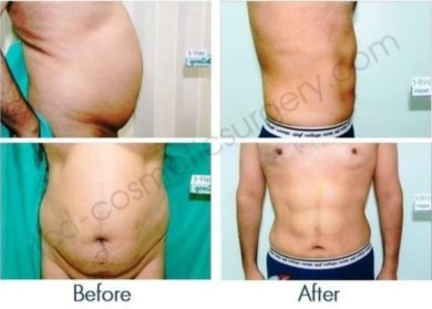 Before and after tummy tuck and liposuction results at ID Clinic Bangkok, improved abdomen contour
