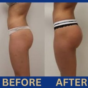 Before and after butt implants at ID Clinic Bangkok, visible gluteal enhancement results