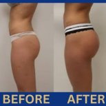 Before and after butt implants at ID Clinic Bangkok, visible gluteal enhancement results