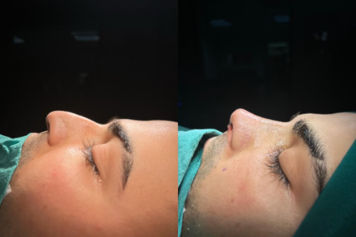 Resultados de rinoplastia antes y después en Atlas University Hospital, perfil nasal mejorado