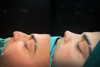نتائج تجميل الأنف قبل وبعد في مستشفى أطلس الجامعي، تحسين شكل الأنف الجانبي