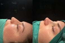 Before and after rhinoplasty results at Atlas University Hospital, improved nose profile