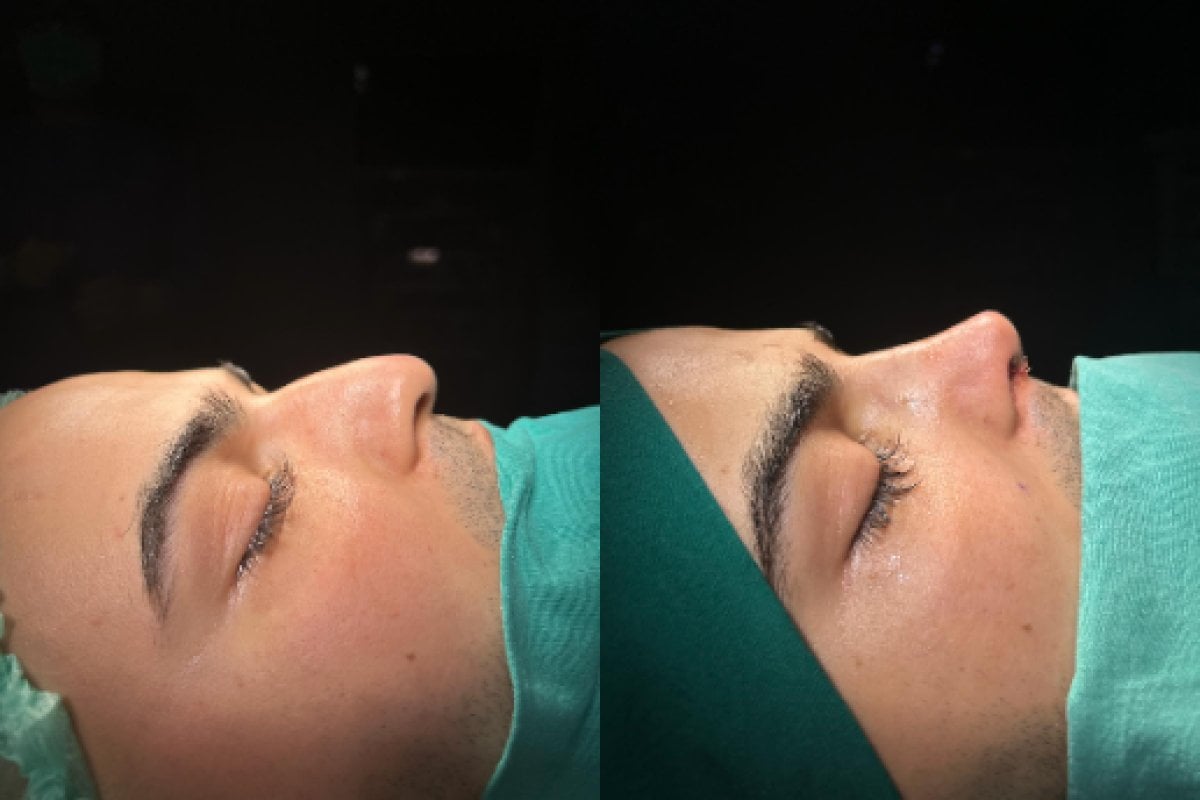 Resultados de rinoplastia antes y después en Atlas University Hospital, remodelación nasal