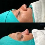 Before and after rhinoplasty results at Atlas University Hospital, improved nose profile shape