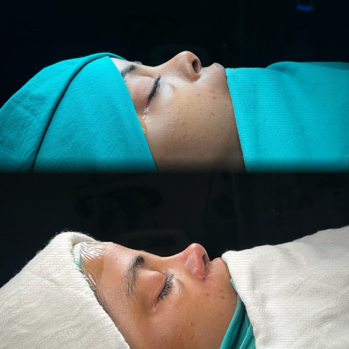 Resultados de rinoplastia antes y después en Atlas University Hospital, mejora visible de la nariz