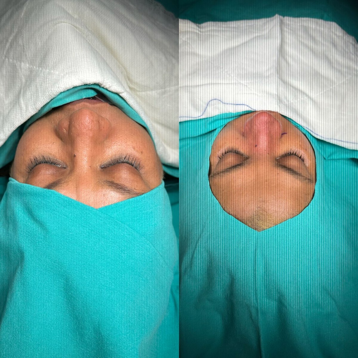 Resultados de rinoplastia antes y después en Atlas University Hospital, remodelación nasal