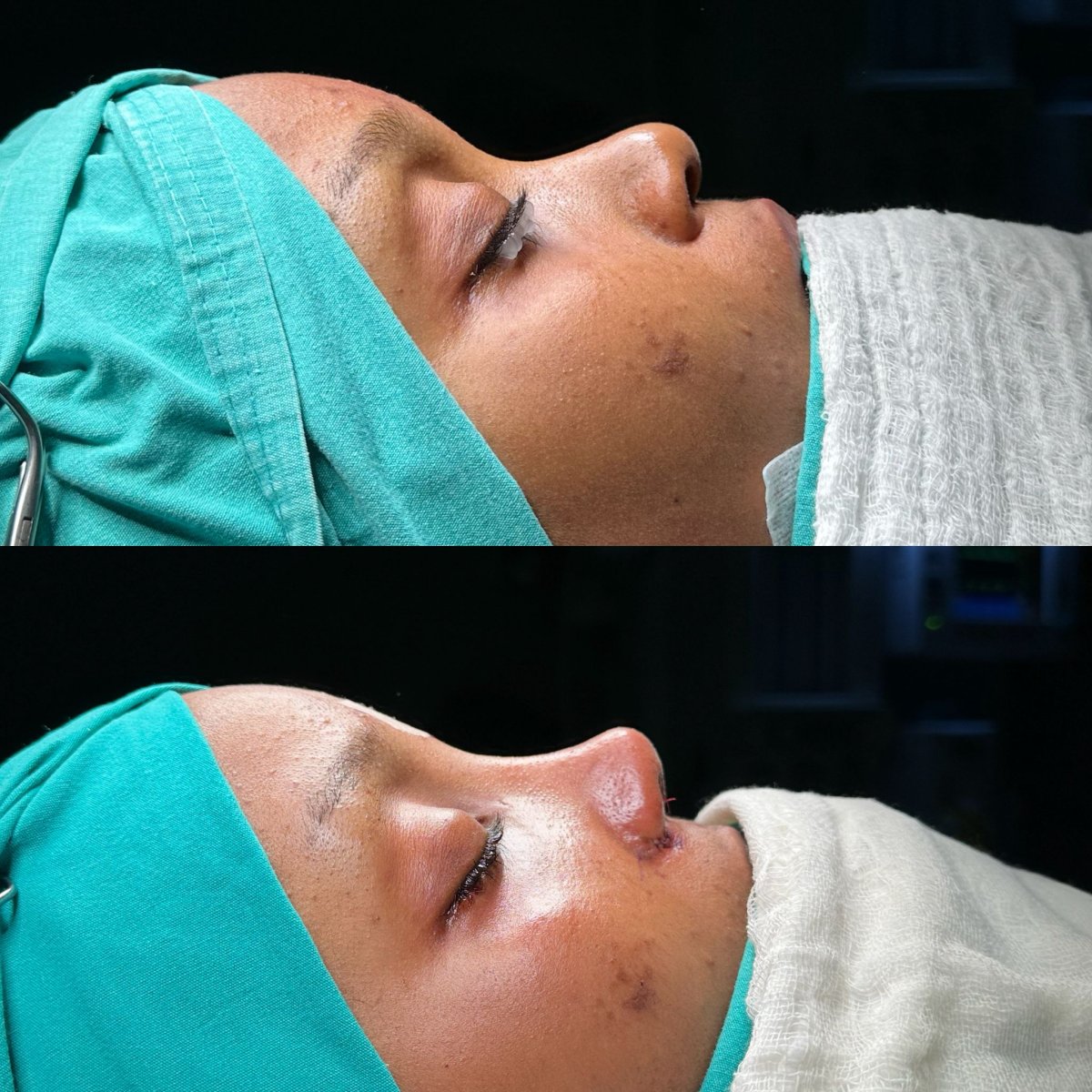 Resultados de rinoplastia antes y después en Atlas University Hospital, remodelación nasal