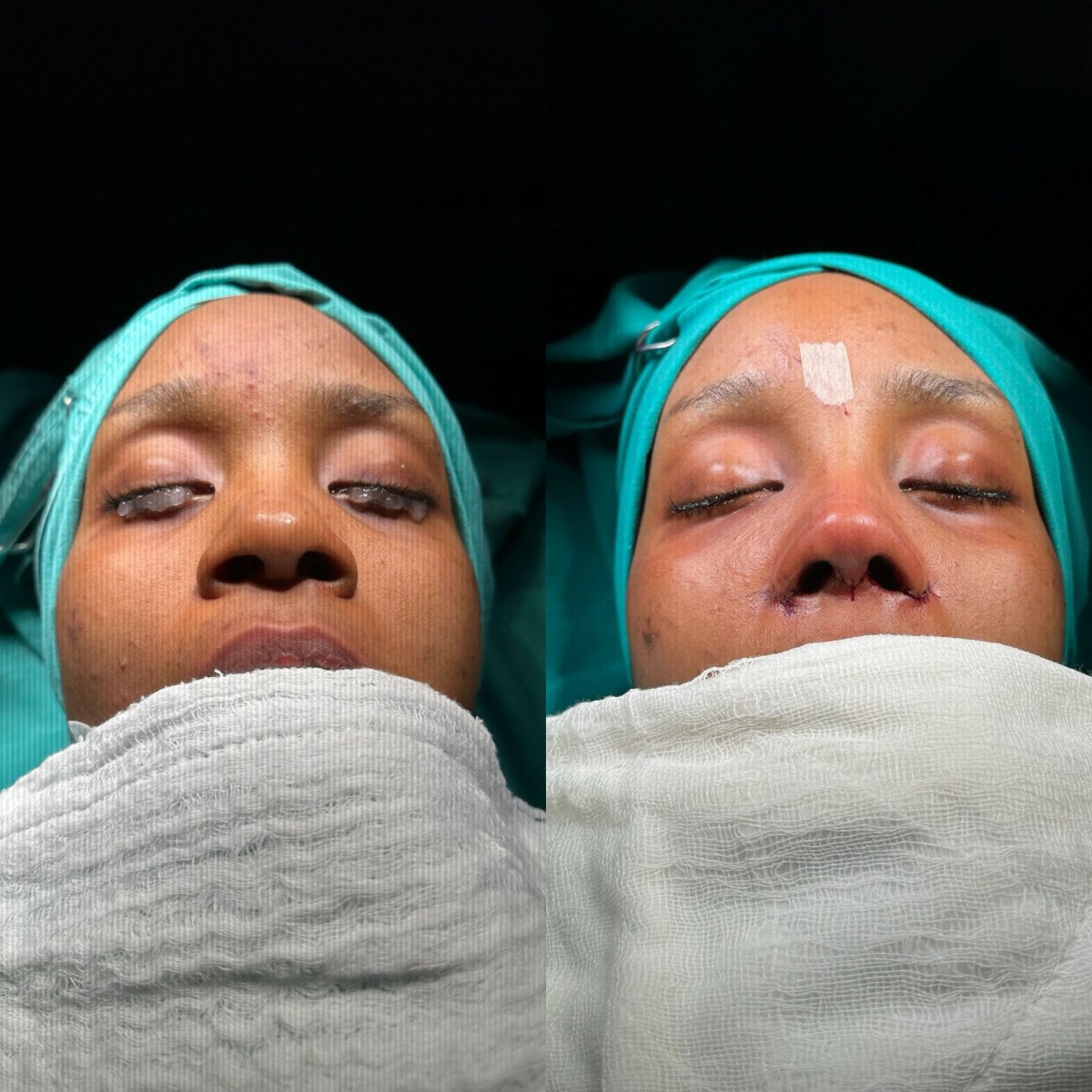 Resultados de rinoplastia antes y después en Atlas University Hospital, remodelación nasal