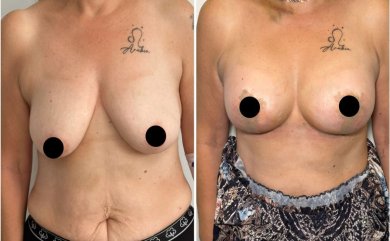 Vorher-nachher Brustimplantate mit Straffung bei Dr. Safa Manav Clinic, verbesserte Brustform