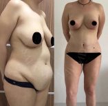 Vorher-nachher-Ergebnis Bauchdeckenstraffung bei Dr. Safa Manav Clinic, sichtbare Kontur