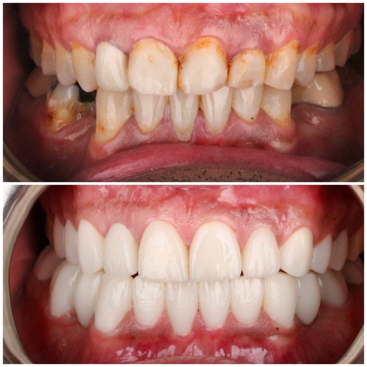 قبل وبعد تركيب تيجان الزركونيا في Dentlotus Clinic – نتائج تجميل الابتسامة