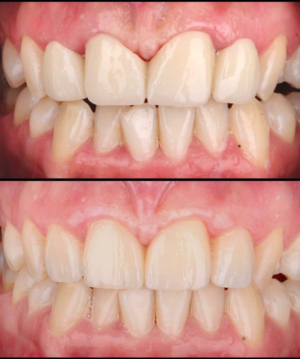 نتائج قبل وبعد تركيب تيجان الزركونيا في Dentlotus Clinic، ابتسامة محسنة