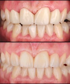 Résultats avant et après pose de couronnes zircone à Dentlotus Clinic, sourire amélioré