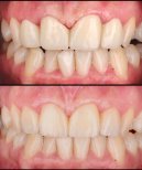 Résultats avant et après pose de couronnes zircone à Dentlotus Clinic, sourire amélioré