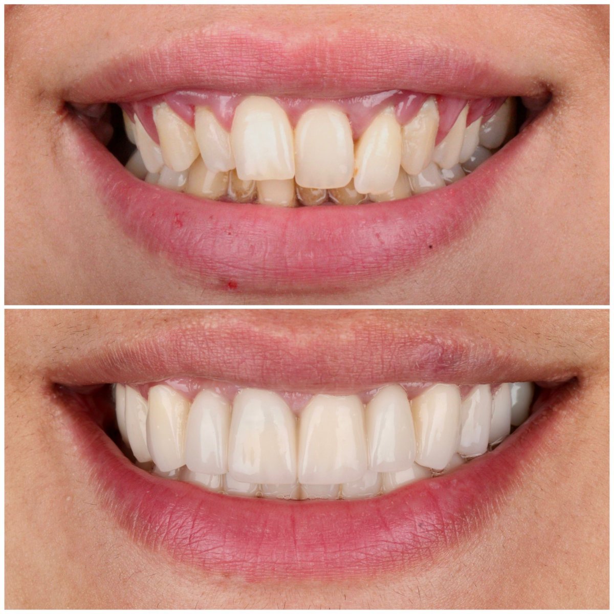 نتائج قبل وبعد تركيب تيجان الزركونيا في Dentlotus Clinic – تحسين مظهر الابتسامة