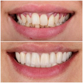 Résultats avant/après couronnes zircone à Dentlotus Clinic – sourire amélioré