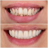 Résultats avant/après couronnes zircone à Dentlotus Clinic – sourire amélioré