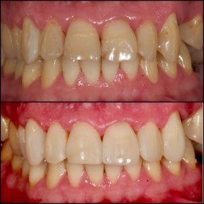 Before and after dental bonding results at Dentlotus Clinic – improved tooth shape and color