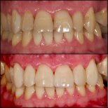 Before and after dental bonding results at Dentlotus Clinic – improved tooth shape and color