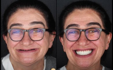 Resultados antes y después de implantes All-on-6 en Dentlotus Clinic – restauración total de sonrisa