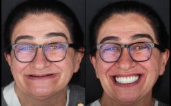 Resultados antes y después de implantes All-on-6 en Dentlotus Clinic – restauración total de sonrisa