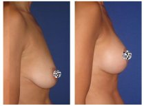 Résultats avant/après lifting mammaire au Centro Médico Teknon, amélioration du galbe