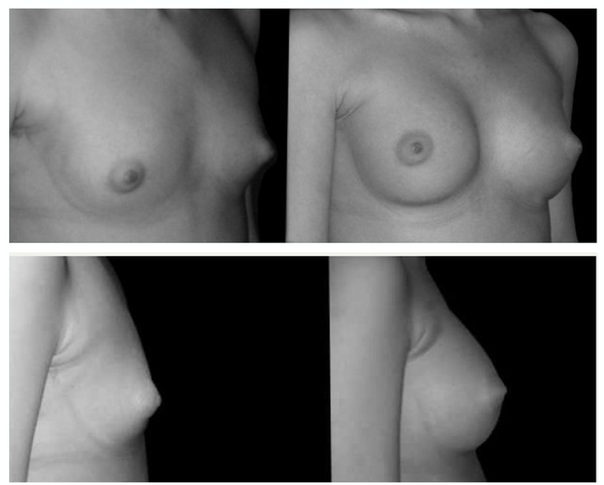 Vorher-nachher-Ergebnis Bruststraffung bei Centro Médico Teknon, verbesserte Brustform