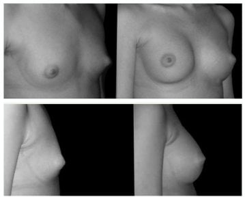 Resultados de antes y después de mastopexia en Centro Médico Teknon, mejor contorno mamario