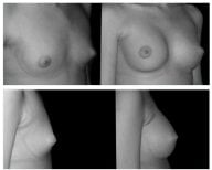 Resultados de antes y después de mastopexia en Centro Médico Teknon, mejor contorno mamario