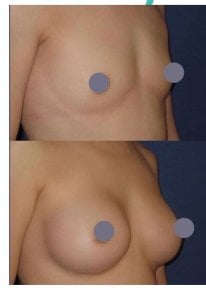 Resultados antes y después de mastopexia en Centro Médico Teknon, mejora del contorno mamario