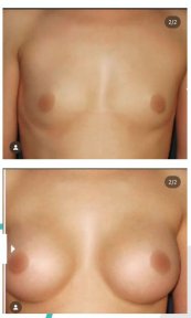 Resultados antes y después de mastopexia en Centro Médico Teknon, mejora del contorno mamario