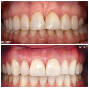 Before and after dental crown installation results at Dentinno Dental Clinic, improved smile