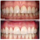 Before and after dental crown installation results at Dentinno Dental Clinic, improved smile