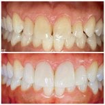 Before and after dental crown installation results at Dentinno Dental Clinic, improved smile