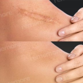 Vorher-nachher-Ergebnis der Stammzelltherapie zur Narbenreduktion im Memorial Bahçelievler Hospital