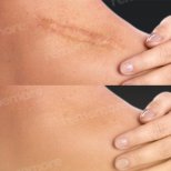 Vorher-nachher-Ergebnis der Stammzelltherapie zur Narbenreduktion im Memorial Bahçelievler Hospital