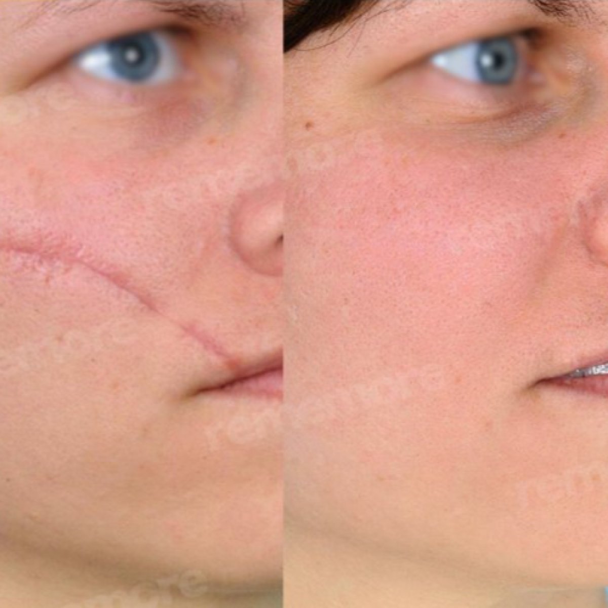 Antes y después de terapia con células madre para cicatriz facial en Memorial Bahçelievler