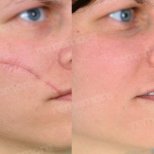Vorher-nachher-Ergebnis Stammzelltherapie zur Narbenreduktion im Gesicht Memorial Bahçelievler