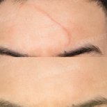 Vorher-nachher-Ergebnis der Stammzelltherapie zur Narbenentfernung im Memorial Bahçelievler