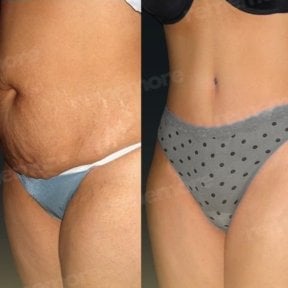 Resultados de liposucción antes y después en Memorial Ankara Hospital, contorno abdominal visible