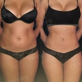 Resultados de liposucción antes y después en Memorial Ankara Hospital, contorno mejorado