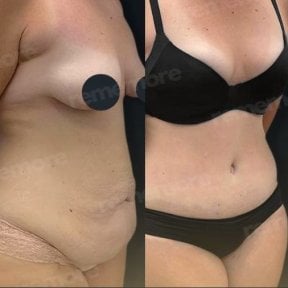 Resultados de liposucción antes y después en Memorial Ankara Hospital, contorno abdominal mejorado