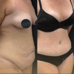 Resultados de liposucción antes y después en Memorial Ankara Hospital, contorno abdominal mejorado