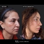 Before and after neck lift results at VG Plastic Surgery – visible jawline and neck contour