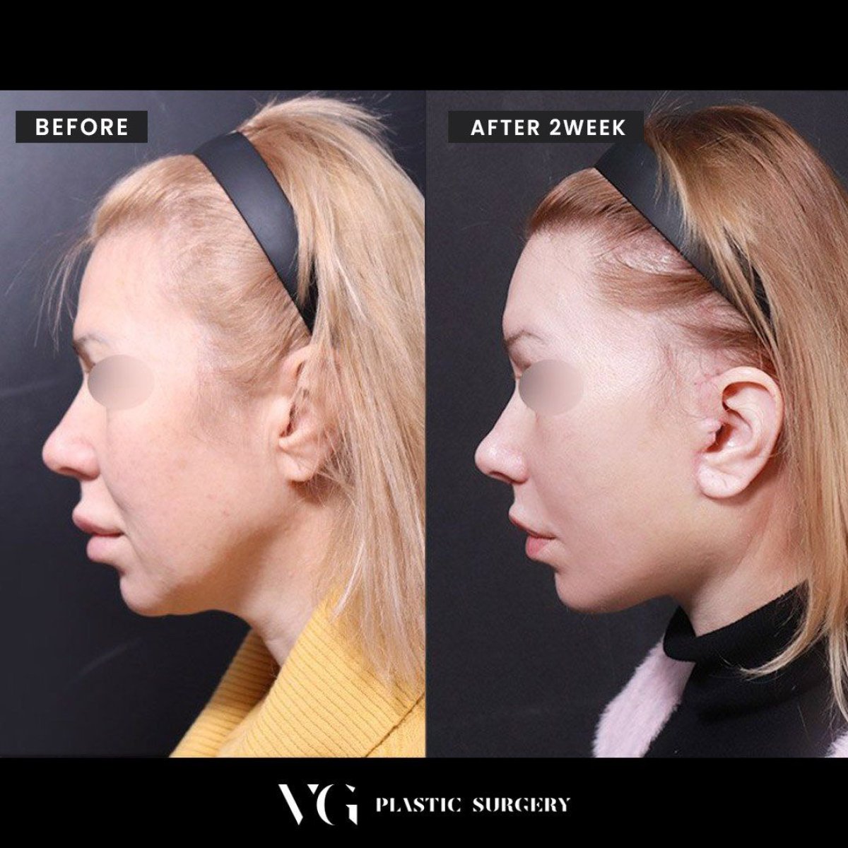 نتائج شد الرقبة قبل وبعد في VG Plastic Surgery – تحسين خط الفك وتحديد الرقبة