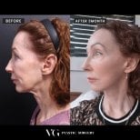 Before and after neck lift results at VG Plastic Surgery – visible neck and jawline improvement